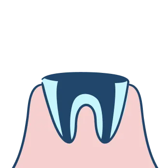 重度のむし歯